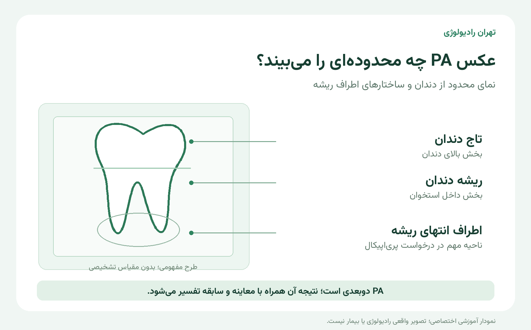 نمودار مفهومی و بدون مقیاس از تاج، ریشه و ناحیه اطراف انتهای ریشه برای توضیح عکس PA؛ تصویر بیمار نیست
